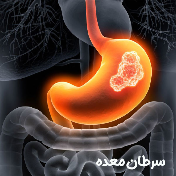 سرطان معده - دکتر مهدی آرامش - drmehdiaramesh.com