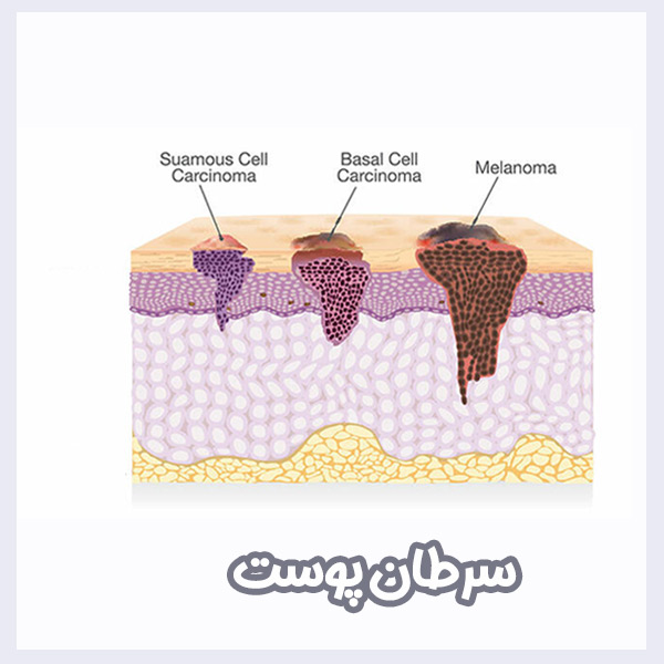 سرطان پوست - دکتر مهدی آرامش - drmehdiaramesh.com