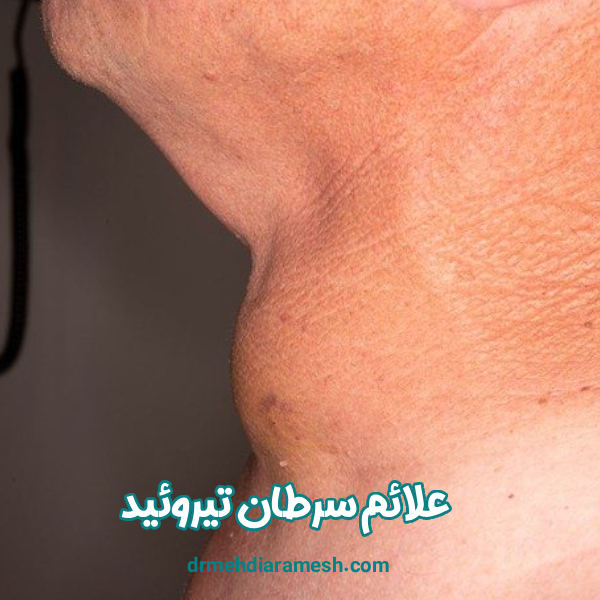 علائم سرطان تیروئید - دکتر مهدی آرامش