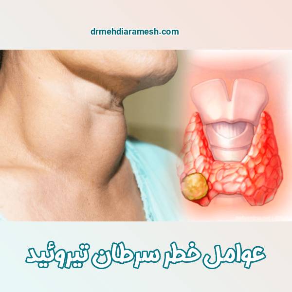 عوامل خطر سرطان تیروئید | دکتر مهدی آرامش