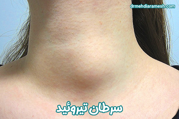 سرطان تیروئید - دکتر مهدی آرامش