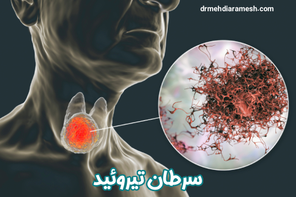 سرطان تیروئید - دکتر مهدی آرامش