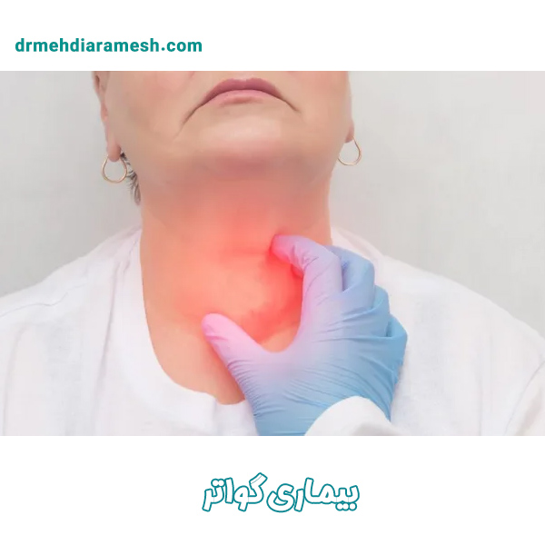 بیماری گواتر - دکتر مهدی آرامش