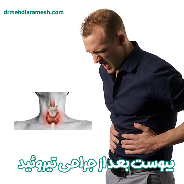 یبوست بعد از جراحی تیروئید - دکتر ارامش