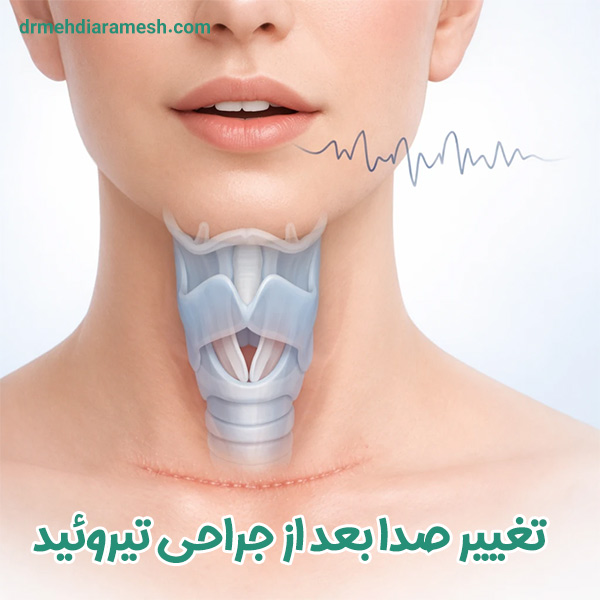 تغییر صدا بعد از جراحی تیروئید - دکتر آرامش
